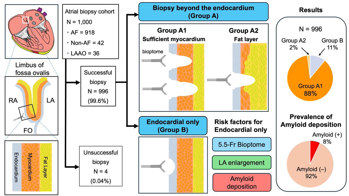 Echo-guided atrial biopsy was safe and feasible in 1000 cases.
But atrial enlargement, small bioptomes, and amyloid deposition led to failed myocardial tissue acquisition.
By Takanori Yamaguchi et al <a href="/tayamagu/">Takanori Yamaguchi</a>
doi.org/10.1253/circre…
#circ_rep #CardioX