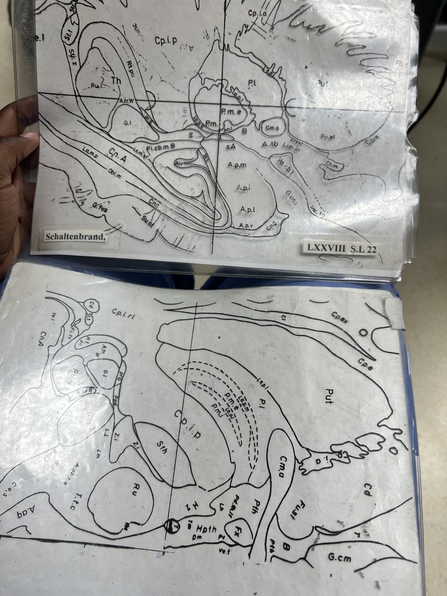 SpelmanCollege's tweet image. From watching Gifted Hands to researching Parkinson’s at Vanderbilt, Nicole Anyanwu, C’2026, is boldly pursuing her dream of becoming a neurosurgeon. This summer, she’s back in Dr. Sara K. Bick’s lab analyzing patient data with MATLAB and contributing to groundbreaking…