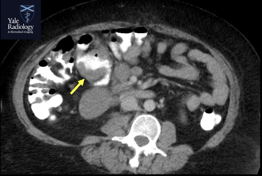 Mahan_Mathur's tweet image. TEACHING COD: great example of small bowel lymphoma – mural soft tissue thickening with "aneurysmal" dilatation of bowel + adjacent lymphadenopathy#yaleradiology #FOAMrad #FOAMed #radres #medstudent #radiology
@RadDiscord #MedTwitter @YaleRadRes