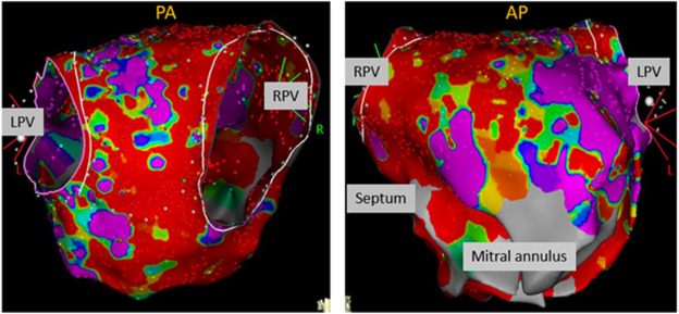 PennCardiology's tweet image. How effective is #catheterablation for atrial #arrhythmias in those w/ cardiac amyloidosis?
Find out ➡️ spr.ly/601745TnX
@Dr_Markman @DrMatthewHyman @andresenriqueza @Dr_Mike_Fradley @DrFerminGarcia @Dr_Nazarian_EP @DavidCallans @rdschaller @adrian_petzl @AlirezaOraii