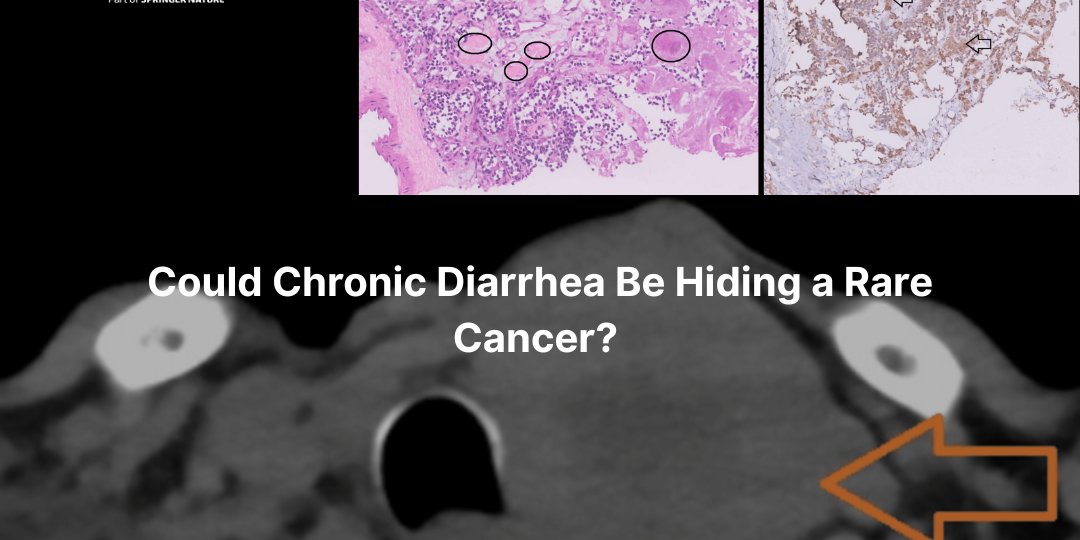 65-year-old woman’s chronic diarrhea revealed metastatic medullary thyroid carcinoma,, a neuroendocrine tumor often misdiagnosed. Early FNAC, elevated calcitonin &amp; CEA guided targeted therapy.
Think beyond the gut. Read more: hubs.la/Q03vZ4Y10
#Cureus #Endocrinology
