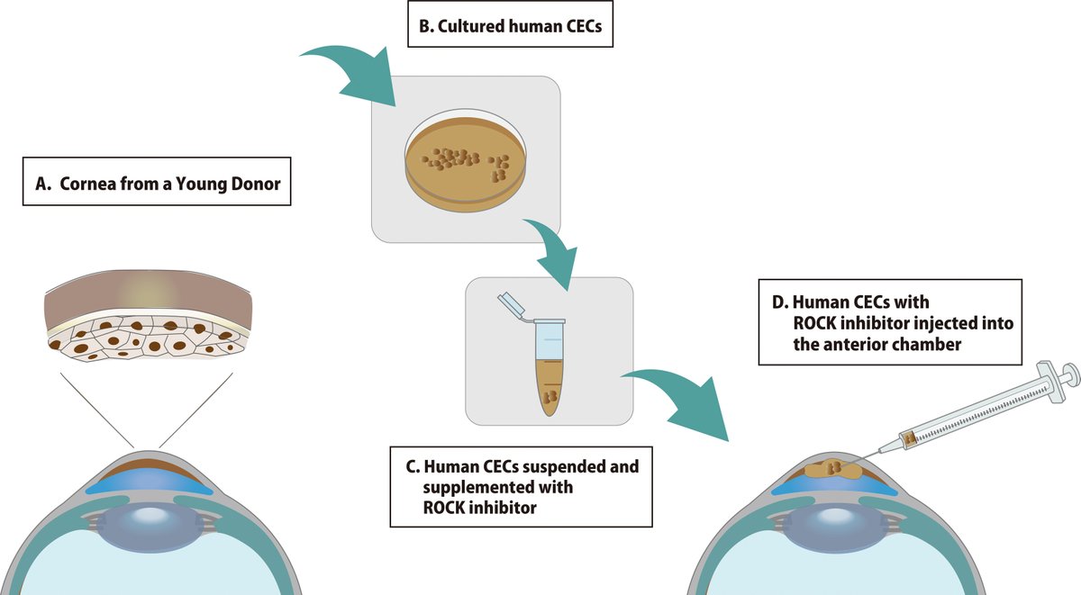 Long-Term Corneal Rejuvenation after Transplantation of Cultured Human Corneal Endothelial Cells
ow.ly/J0mg50Wf35Z