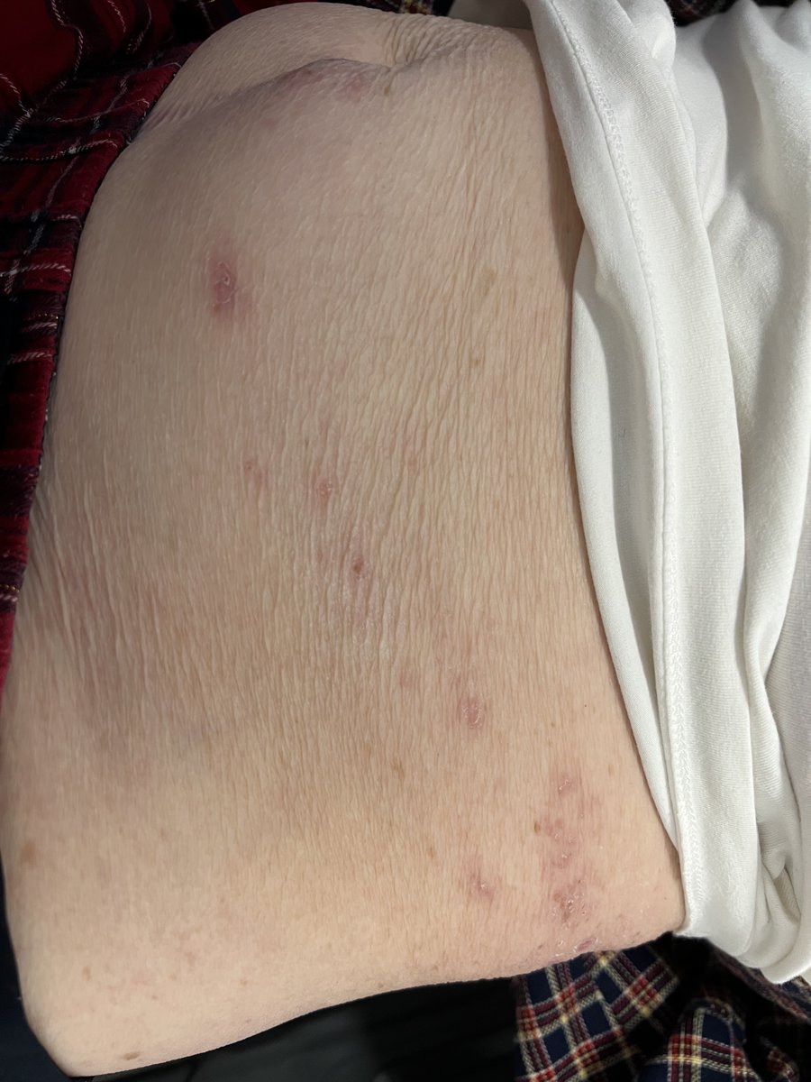 drkeithsiau's tweet photo. This 80F had a 4 week history of severe left sided abdominal pain with no clues on blood tests and CT scan, and no response to various analgesics and antibiotics. A mystery until someone physically examined her. What’s the diagnosis? https://t.co/10LLUOmpyT