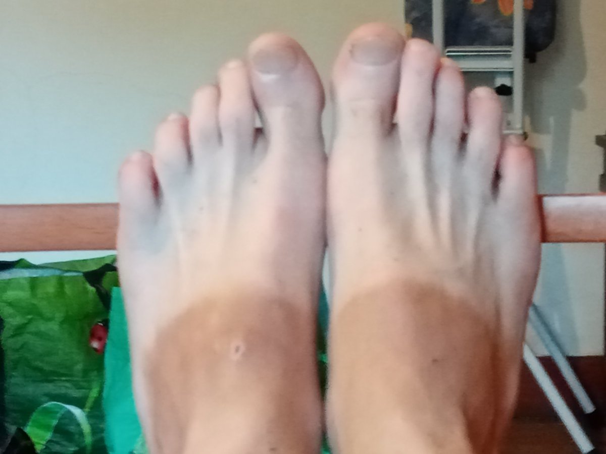 Parezco un árabe con la punta de los pies trasplantados