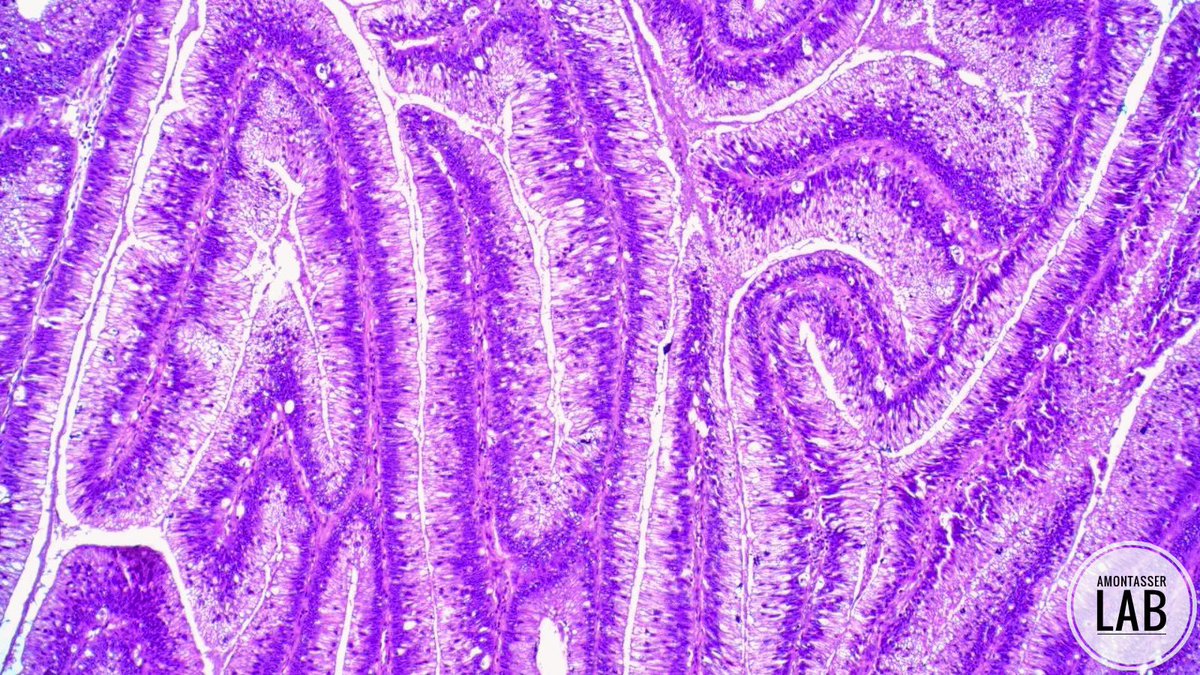 AMontasserMD's tweet image. Low grade dysplasia 🤩
#GIpath #Pathology #PathX #PathArt