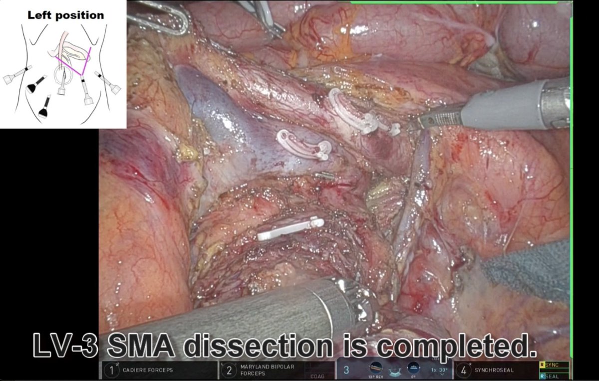 EAVegaMD's tweet image. 🎥 New #HowIDoIt video from @SSATNews 
@YosukeInoueHPB and team showcase their open &amp;amp; 🤖 PD with an SMA-🥇 approach – enhancing safety and oncologic outcomes in panc surgery.
Watch now ➡️ ssat.com/video/robotic.…
@AHPBA @EAHPBA @JSHBPS @chiaro_del @KenichiroUemura @ObaAtsushi…