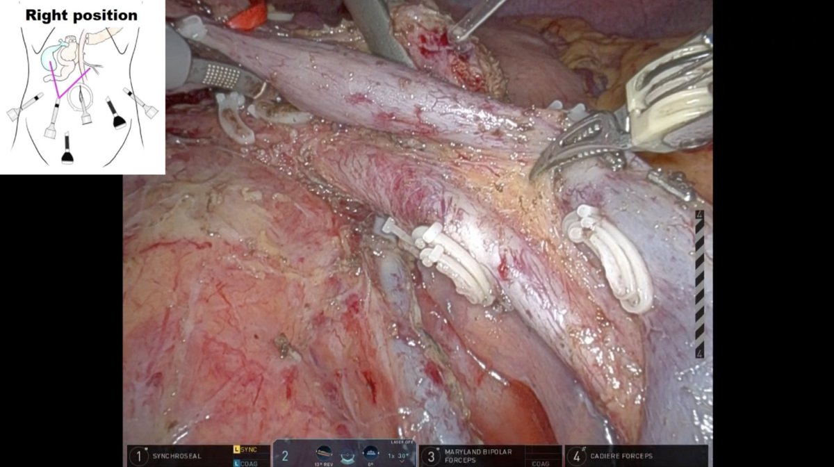 EAVegaMD's tweet image. 🎥 New #HowIDoIt video from @SSATNews 
@YosukeInoueHPB and team showcase their open &amp;amp; 🤖 PD with an SMA-🥇 approach – enhancing safety and oncologic outcomes in panc surgery.
Watch now ➡️ ssat.com/video/robotic.…
@AHPBA @EAHPBA @JSHBPS @chiaro_del @KenichiroUemura @ObaAtsushi…