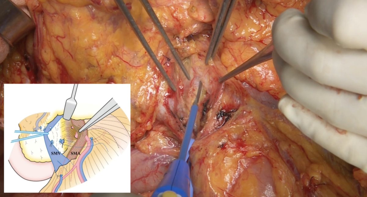 EAVegaMD's tweet image. 🎥 New #HowIDoIt video from @SSATNews 
@YosukeInoueHPB and team showcase their open &amp;amp; 🤖 PD with an SMA-🥇 approach – enhancing safety and oncologic outcomes in panc surgery.
Watch now ➡️ ssat.com/video/robotic.…
@AHPBA @EAHPBA @JSHBPS @chiaro_del @KenichiroUemura @ObaAtsushi…