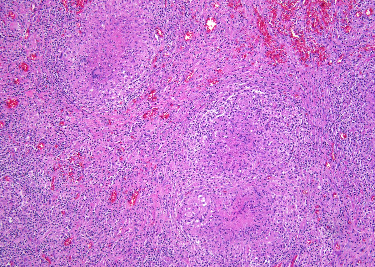 NOT a lymph node FNA, this spectacular cell block is from a pleural effusion of a patient with known history of pulmonary tuberculosis. I've rarely if ever seen that many "necrotizing granulomas" in an effusion sample, some with the classic Langhans giant cells.