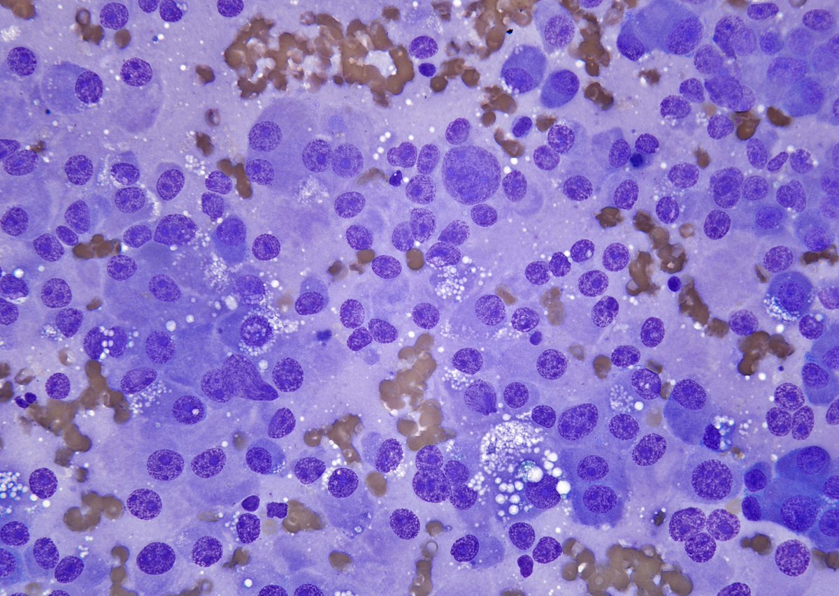 A nice teaching case with classic cytomorphology from today's sign out, "Well-differentiated pancreatic neuroendocrine tumor (PanNET)". In addition to the usual FNA features, also seen here are occasional macronucleoli, isolated nuclear pleomorphism and intracytoplasmic lipid.
