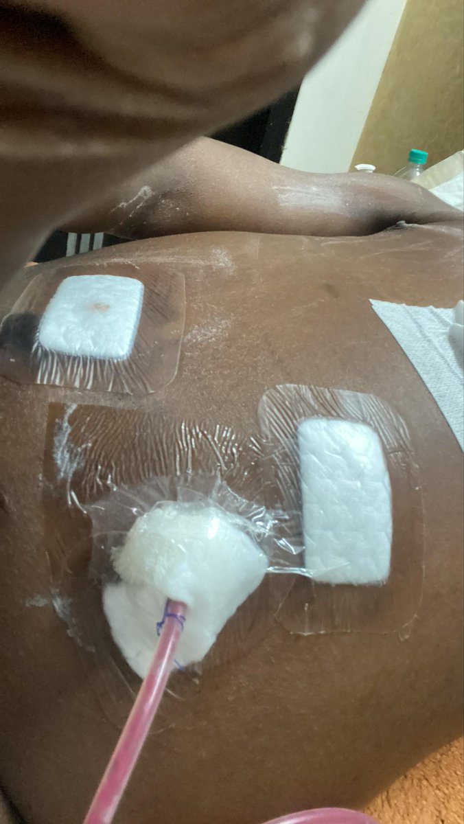 🆘FINAL PUSH TO SAVE ABDULRAZAQ! 
 After over 2 years of pain, struggle and resilience. <a href="/IamAdebajo/">Adebajo Abdulrazaq</a> is finally cleared and scheduled for surgery, but unless the full balance is paid this week, he won’t be attended to. 

Over ₦77M raised,  ₦38M still needed ⏰

Thread👇