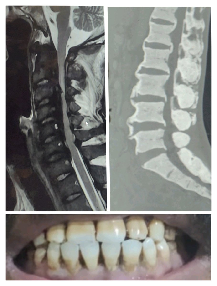 doc_tks_rad's tweet image. SKELETAL FLUOROSIS
🔷Diffuse osteosclerosis / T1 & T2 hypointense marrow on MRI
🔷OPLL & ossification/calcification of other paraspinal ligaments, bony excrescence ➡️spinal canal/foraminal compression➡️radiculomyelopathy
✅Look for dental fluorosis
✅Lab tests: Urine fluoride