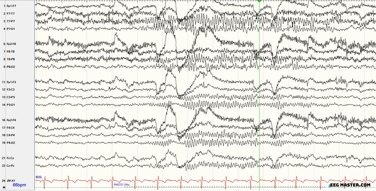 Which of the following best describes pertinent EEG finding from this EEG? 

Photoparoxysmal response
PDR
Photic Driving
Photovoltaic response
Electroretinogram
Photomyogenic response

Click this link to submit your response &amp; read the explanation. 
eegmaster.com/eegmaster/quiz…