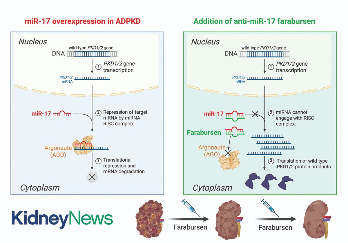 Kenar Jhaveri (@kdjhaveri) on Twitter photo July 2025 ASN Kidney News: Gene Therapy Without a Vector: Harnessing the Wild-Type PKD1/2 Allele in ADPKD kidneynews.org/view/journals/… <a href="/Nephro_Sparks/">Matthew Sparks, MD</a> Arash Ataei <a href="/asnpublications/">ASN Publications</a> July 2025 ASN Kidney News: Gene Therapy Without a Vector: Harnessing the Wild-Type PKD1/2 Allele in ADPKD kidneynews.org/view/journals/… <a href="/Nephro_Sparks/">Matthew Sparks, MD</a> Arash Ataei <a href="/asnpublications/">ASN Publications</a>