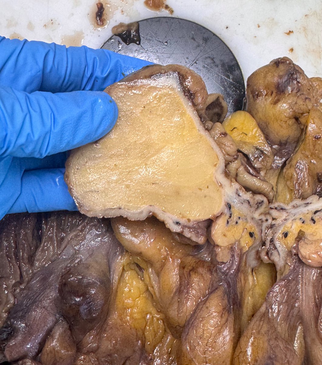 Pathology routine, or as they say — fear often has big eyes. A tumor like this, seemingly obstructing the lumen of the sigmoid colon and measuring about 5 cm in diameter, turned out to be just a lipoma that had simply pushed the epithelium above it.