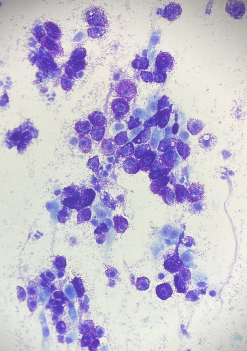 AranzaPinedo's tweet photo. I performed an #FNA on a slowly growing subcutaneous mass on a special patient 🐾 🐕🦺: my dog. This is the Diff-Quik smear. I’ve scheduled her surgery to have it removed. #Cytopathology meets #VetPath 🐶 #Cytology #mastcells https://t.co/whmDCrmvpJ
