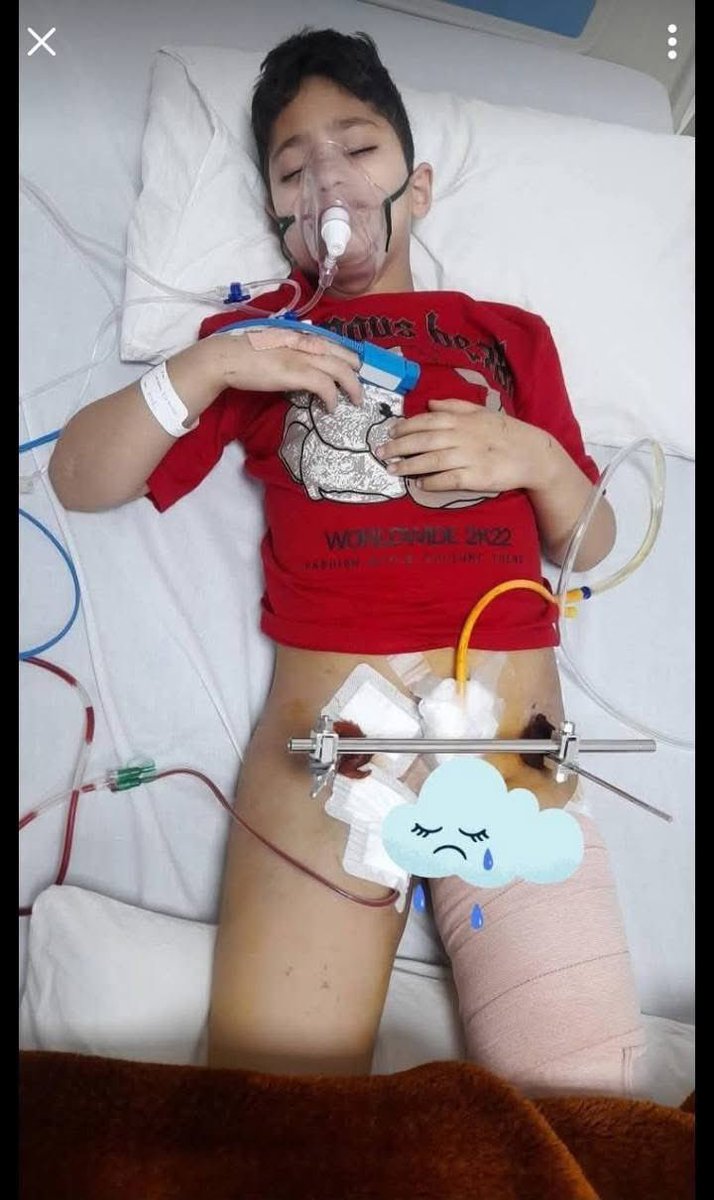 Nawakadal3's tweet image. Message to Hon'ble Education Minister Sakina Itoo Ji:
Respected Madam,
Before reopening schools and talking about class timings, please take a moment to think about the child who can no longer sit in a classroom.
💔 My 7-year-old son Mohammad Usman is lying in a hospital bed…