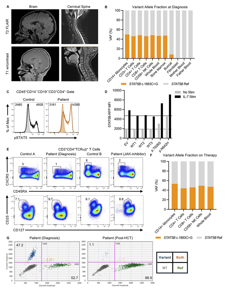 Journal of Human Immunity (@jhumimmunity) on Twitter photo New study from Erica Schmitt, Megan Cooper et al. <a href="/washumedicine/">WashU Medicine</a> describes a patient with a predominantly neurological phenotype, who was found to have a mosaic STAT5B gain-of-function variant and was successfully treated with HCT. hubs.la/Q03wghfs0
#Autoimmunity New study from Erica Schmitt, Megan Cooper et al. <a href="/washumedicine/">WashU Medicine</a> describes a patient with a predominantly neurological phenotype, who was found to have a mosaic STAT5B gain-of-function variant and was successfully treated with HCT. hubs.la/Q03wghfs0
#Autoimmunity