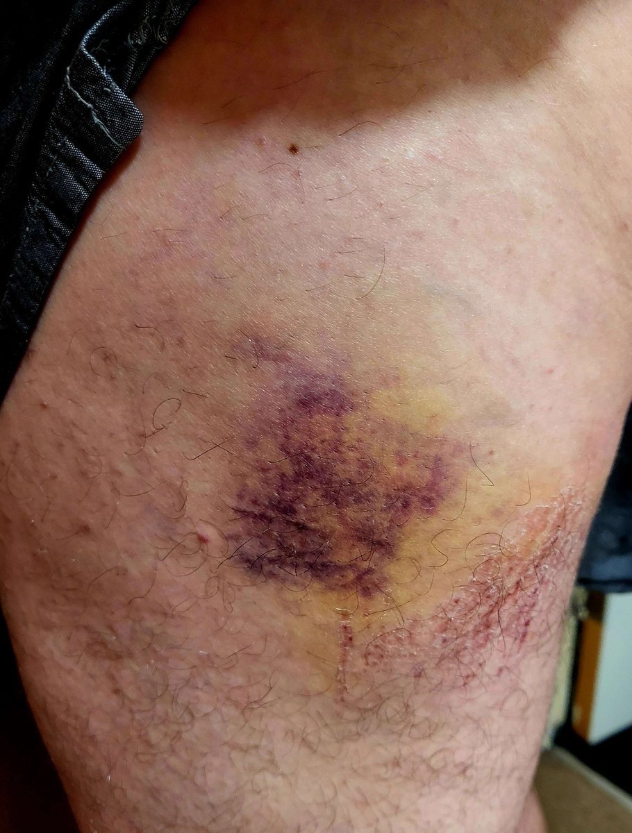 SORRY I HAVEN'T BEEN AROUND AS MUCH, BUT YOU ALL KNOW I FELL DOWN A MAN HOLE AT THE WEEKEND AND AS MUCH AS IM A MANLY FELLA, I BEEN TOLD TO GET MY LEGS CHECKED....BUT WHY DOES THE BRUISING LOOK LIKE A FACE? OR IS IT JUST MY WAVEY BRAIN? <a href="/KickStreaming/">Kick</a> <a href="/KickCommunity/">Kick Community</a>