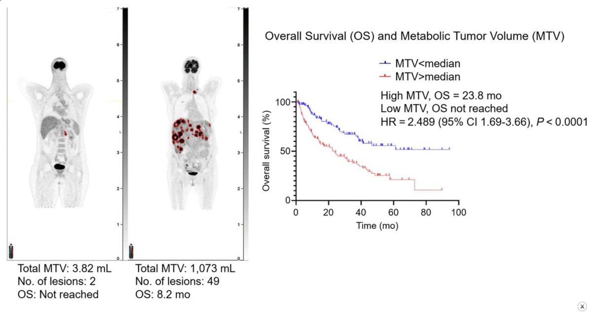 HalletJulie's tweet image. Functional imaging is 🔑in neuroendocrine neoplasms
Lots of info beyond SUV to understand the tumor📊👩🏻💻
Data from 🇦🇺
Metabolic tumor volume is prognostic - associated with
🔬tumor grade
😃survival
To include in reports? 🤔
jnm.snmjournals.org/content/early/…