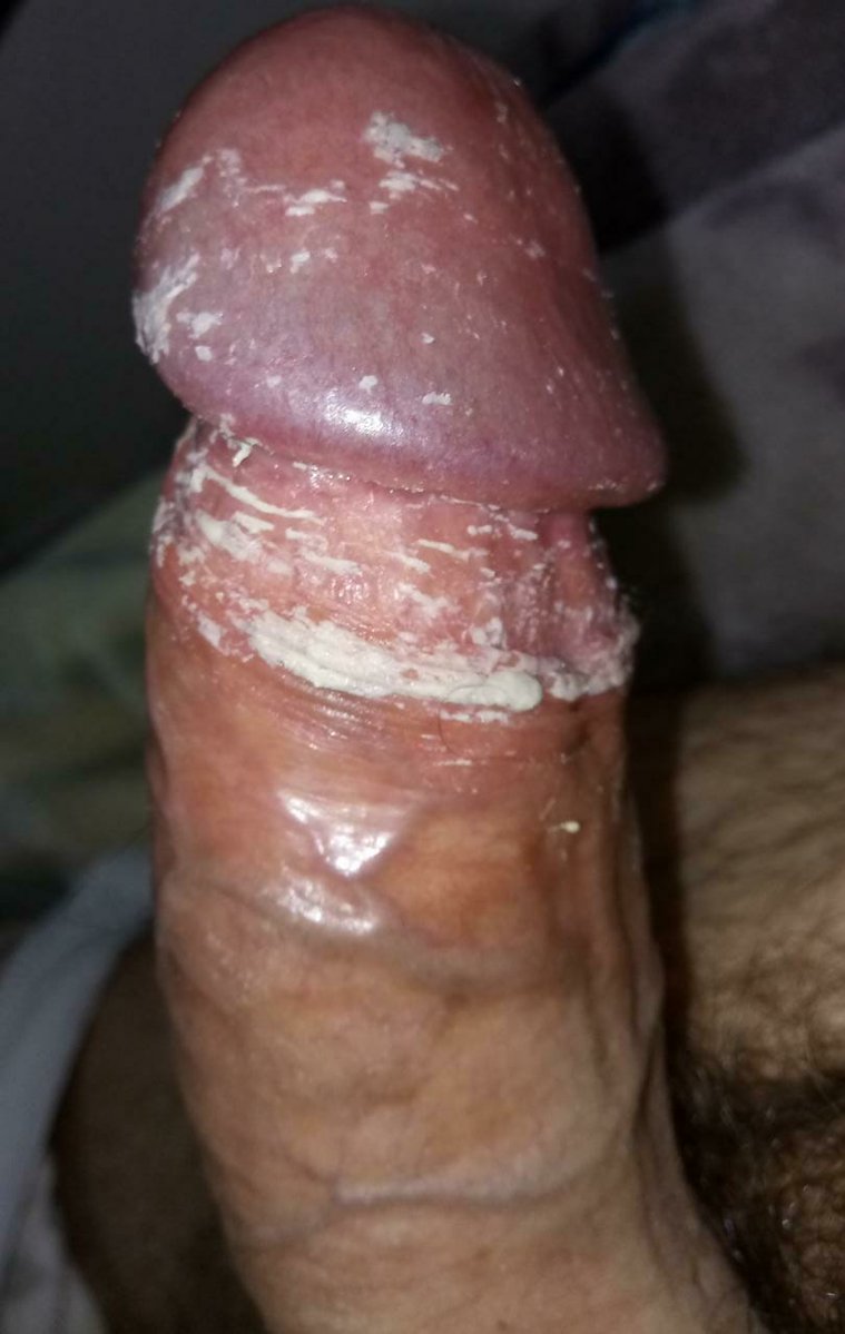 Found cheese! #cheesy #smegma #sebo #sebonarola #uncut