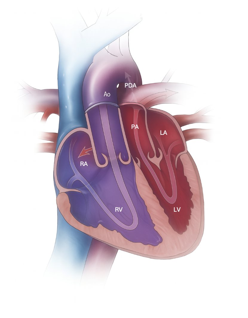 CardioNeo's tweet image. Expanded dTGA and Morphology sections to include schematics + more information on great-vessels configuration. You will find my ppt on d-TGA that I will be giving July 9 at Phoenix Children's Hemodynamics and CHD Bootcamp.
neocardiolab.com/congenital-hea…
neocardiolab.com/congenital-hea…