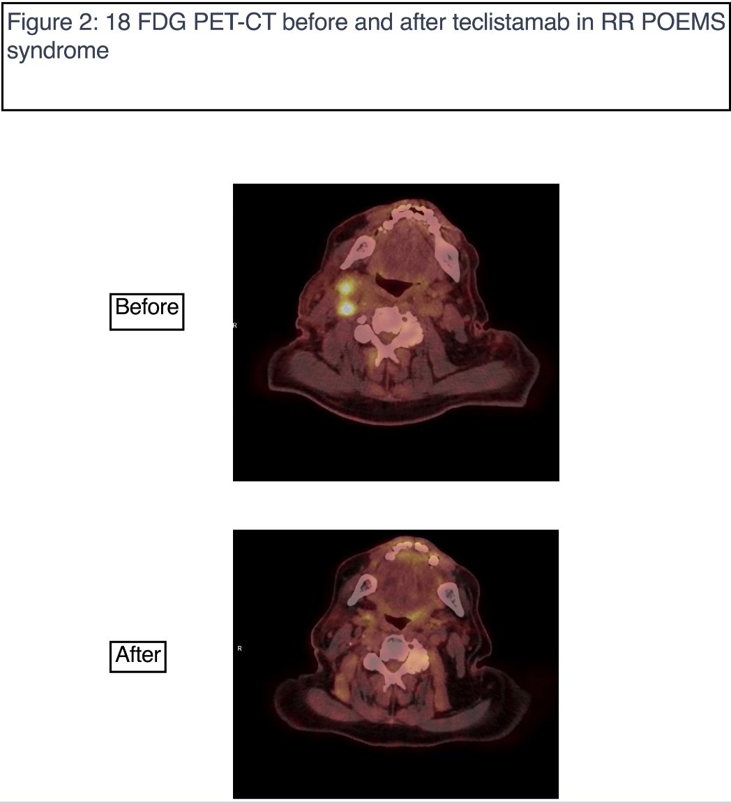 Myeloma_Doc's tweet image. #Myeloma Paper of the Day: Case report of the use of teclistamab for treatment of relapsed/refractory #POEMS syndrome producing a durable biochemical & radiographic remission lasting past drug discontinuation & without any unanticipated toxicities: pubmed.ncbi.nlm.nih.gov/40605704/. #mmsm