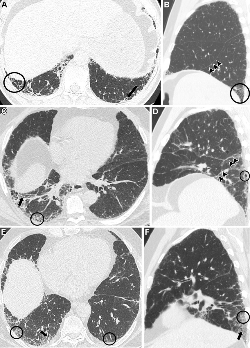 Radiology (@radiology_rsna) on Twitter photo CT is essential in the diagnosis and prognostication of fibrotic interstitial lung disease - take a deep dive into the current state of fibrotic ILD imaging. <a href="/UKYRadiology/">UKY Radiology</a> <a href="/UChicagoRADS/">UChicago Radiology</a> <a href="/BrixeyAnu/">Anu Brixey, MD</a> <a href="/ChestXrayDoc/">Stephen Hobbs</a> <a href="/SethKligs/">Seth Kligerman</a> <a href="/jonherochung/">Jonathan Chung, MD</a> bit.ly/40BX55B CT is essential in the diagnosis and prognostication of fibrotic interstitial lung disease - take a deep dive into the current state of fibrotic ILD imaging. <a href="/UKYRadiology/">UKY Radiology</a> <a href="/UChicagoRADS/">UChicago Radiology</a> <a href="/BrixeyAnu/">Anu Brixey, MD</a> <a href="/ChestXrayDoc/">Stephen Hobbs</a> <a href="/SethKligs/">Seth Kligerman</a> <a href="/jonherochung/">Jonathan Chung, MD</a> bit.ly/40BX55B