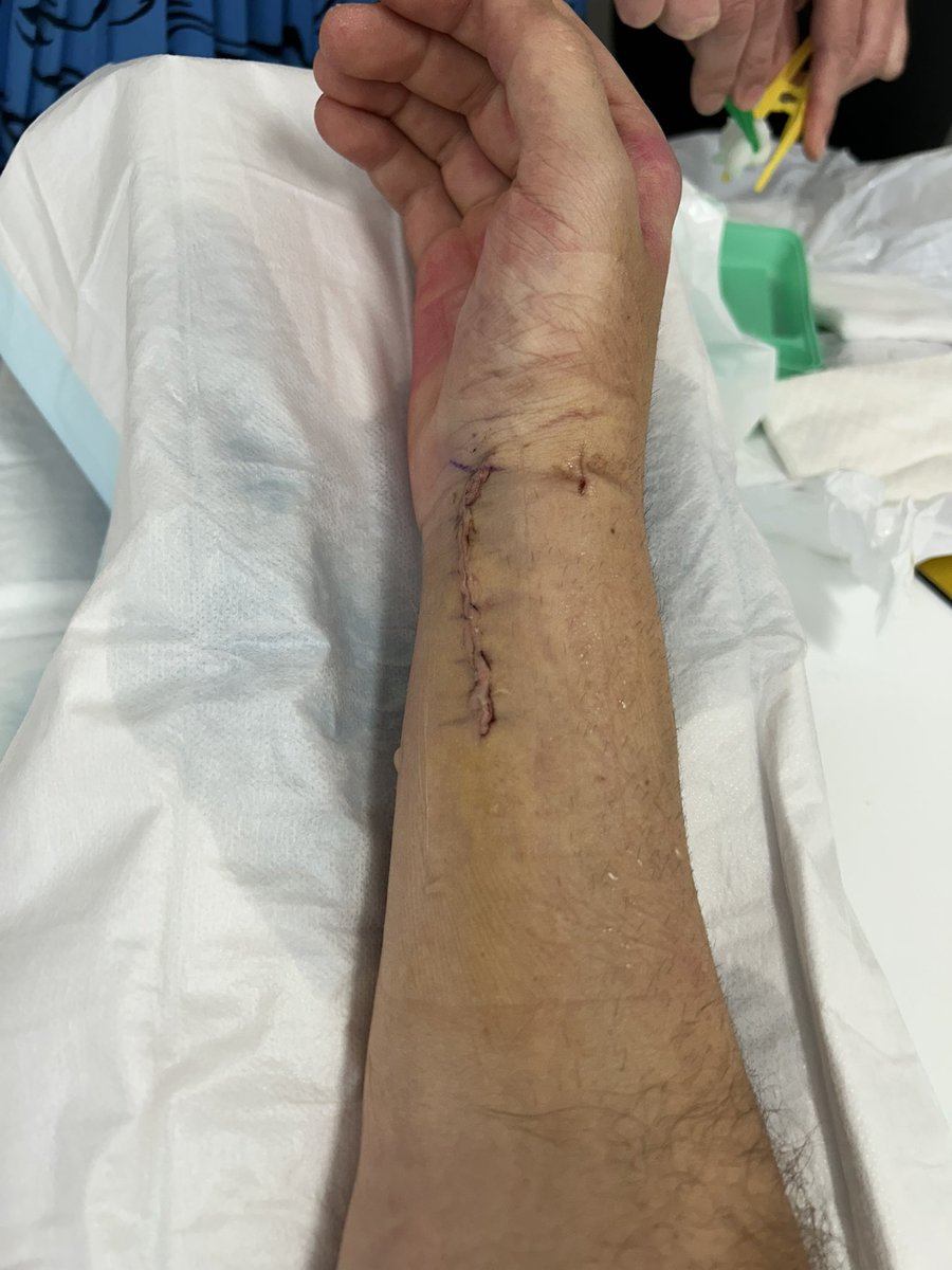 First time seeing my arm since the injury. Recovery and rehab only started yesterday but the healing process is going really well. Having to do things one handed isn’t too bad unless it’s something you need two hands for like gaming (which I am missing playing a tonne). Thanks to