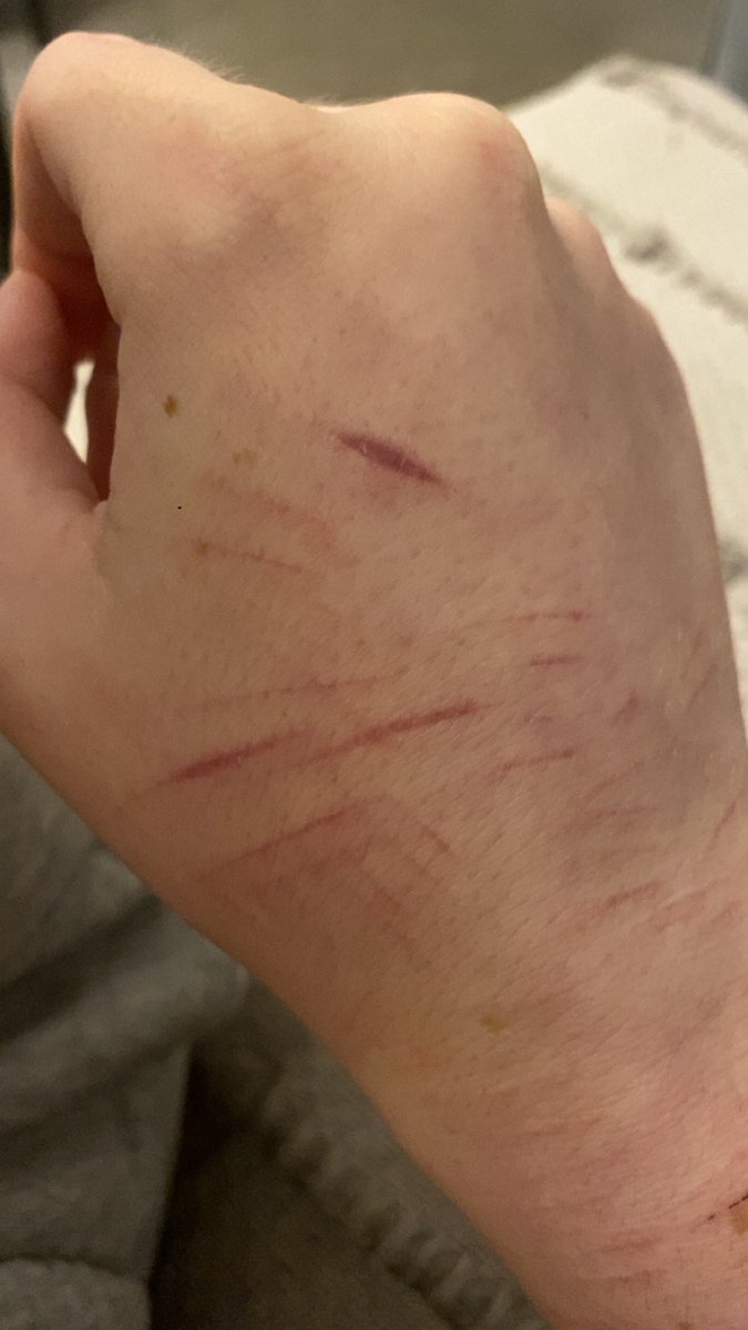 iwantbetterskin's tweet photo. my hand scars turn purple when i’m cold and reddish when i’m warm 😭😭 https://t.co/PYTh4dypO4