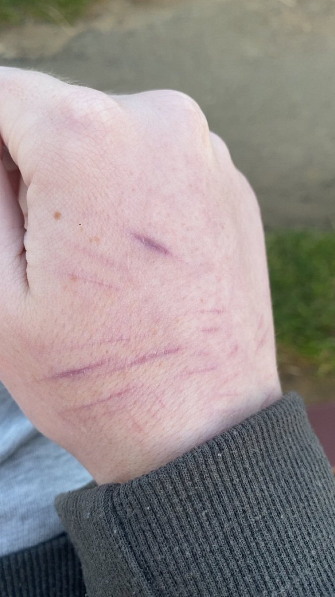 iwantbetterskin's tweet photo. my hand scars turn purple when i’m cold and reddish when i’m warm 😭😭 https://t.co/PYTh4dypO4