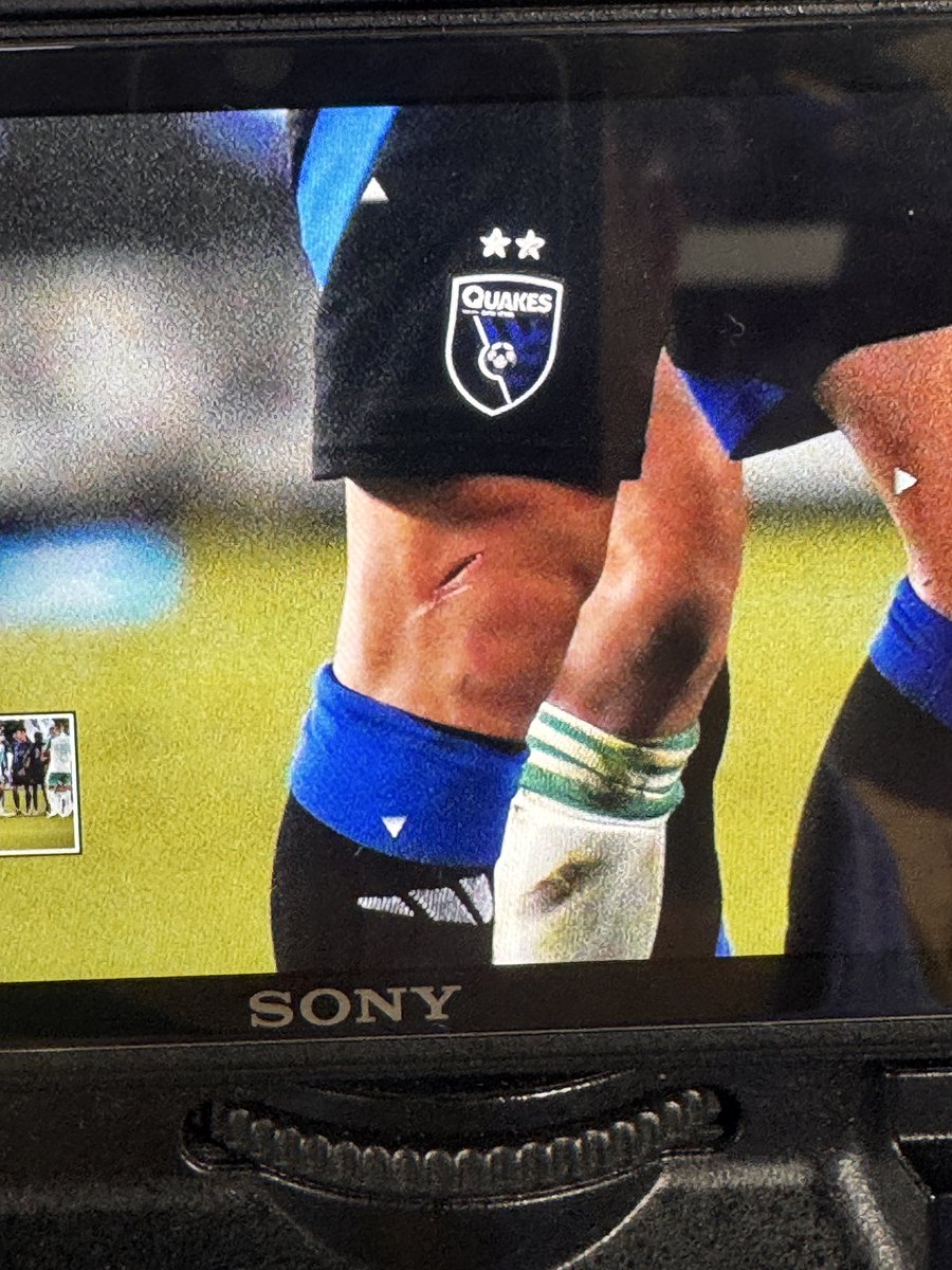 In case you were wondering… <a href="/CriisEspinoza7/">Cristian Espinoza ⚽️</a> had to be subbed off because he got this gash on a tackle that the ref didn’t call as a red.
The <a href="/SJEarthquakes/">San Jose Earthquakes</a> are still tied with <a href="/AustinFC/">Austin FC</a> in the <a href="/opencup/">U.S. Open Cup</a> 
📸 <a href="/darioodoes/">Dario Cruz</a>