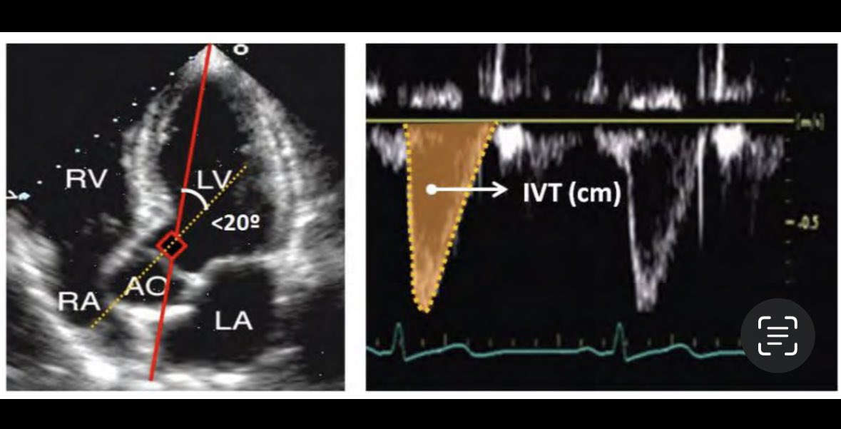 DrCriticalCare's tweet photo. Cómo Medir Correctamente el ITV TSVI?
✅Siempre con Transductor sectorial
✅ De preferencia realizarlo con EKG
✅Vista Adecuada: Apical 5 Cámaras
✅Alineación Adecuada: el septum IV debe estar lo más alineado posible al Doppler Pulsado con una angulacion menor a 20 Grados.
✅Ubicación Adecuada: El Volumen muestra deberá estar justo antes de la válvula aórtica a 1-2 mm en el espectro Doppler solo se deberá observar el chasquido de cierre de válvula. 
✅Configuración Adecuada: ajusta Ganancia y filtros para un flujo en bala o “Bullet”.
✅ Trazado adecuado: usa trazado manual con 3 mediciones en sinusal y 5 en fibrilacion auricular.