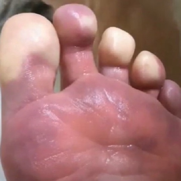 For most sufferers, Raynaud’s isn’t serious but that doesn’t mean it shouldn’t be taken seriously. Learn about the blues down to your toes, here: bit.ly/385Hm4c #raynauds
