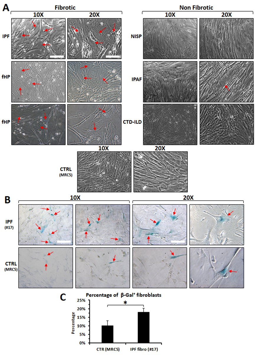 Landmark_IMR's tweet image. 🚨 #New study alert!
🚨 Discover how BAL-derived fibroblasts offer a powerful 2D/3D in vitro model to study pulmonary fibrosis 🔬—a valuable tool for ILD research!
📝 By Paolo Giannoni, Emanuela Barisione, Marco Grosso, Maria Bianca Bertolotto, Paola Altieri, Federico Carbone,…
