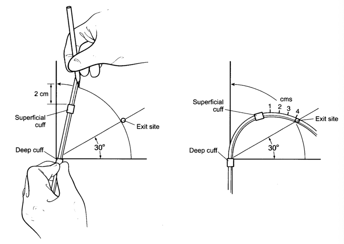 Técnica de tunelización de catéter:

1️⃣ Traza un arco c/catéter como compás 2 cm del manguito superficial
2️⃣ Marca salida en la unión de 2/3 medial y lateral del arco
3️⃣ Forme túnel doblando el catéter a 4 cm del manguito del manguito sup

#NephperlsMx #InterventionalNephrology