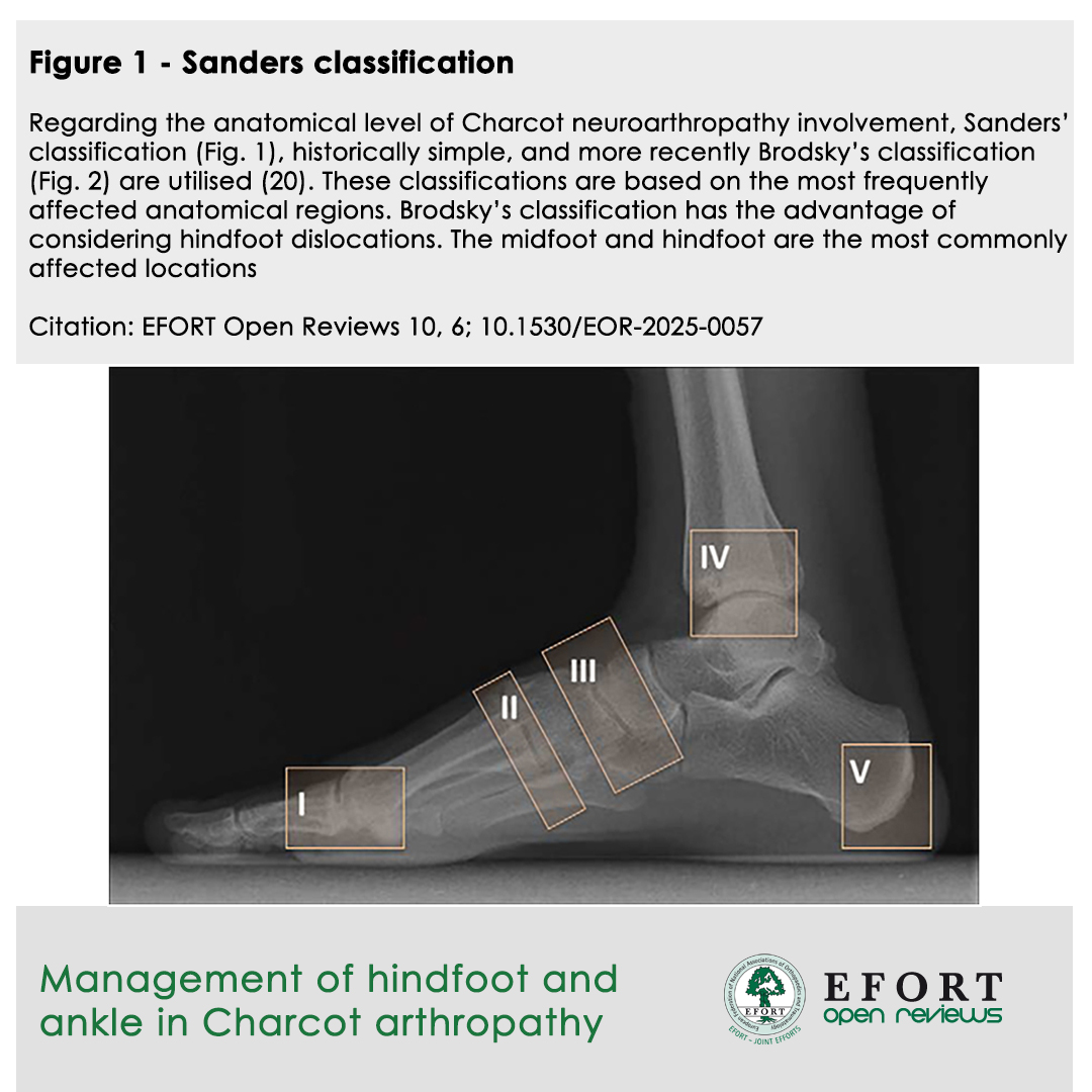 #EOR article "Management of Hindfoot &amp; Ankle in #Charcot Arthropathy"
🦶 Essential read on diagnosis, evolving #SurgicalTechniques &amp; improving patient QoL. High impact for #DiabeticFoot care
🔗 bit.ly/EOR250601

#Orthopaedics #TraumaSurgery #EORJournal #FootAndAnkle #EFORT