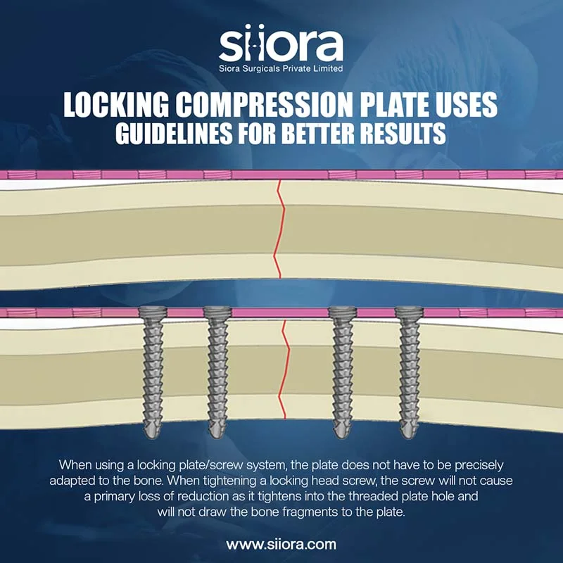 siorasurgicals's tweet image. A Locking Compression Plate is a type of orthopedic implant used to stabilize bone fragments.
siiora.com/blogs/locking-…
#LockingCompressionPlate #LCP #OrthopedicImplants #SurgicalImplants #SurgicalImplants #InternalFixation #SioraSurgicals