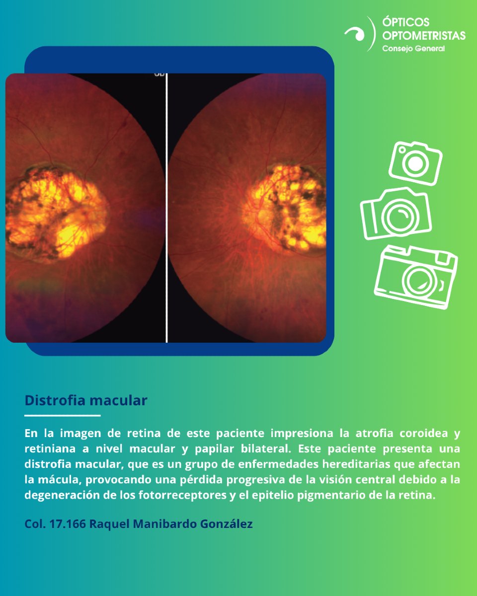 Cgcoo_es's tweet photo. 🏆📸#ConcursoFotografiaCientificaOcular | Foto seleccionada para optar al premio Carlos López H. de fotografía ocular Topcon España #LaGacetaCGCOO #Gaceta614 #distrofia #macular https://t.co/TgaAmiEWN8
