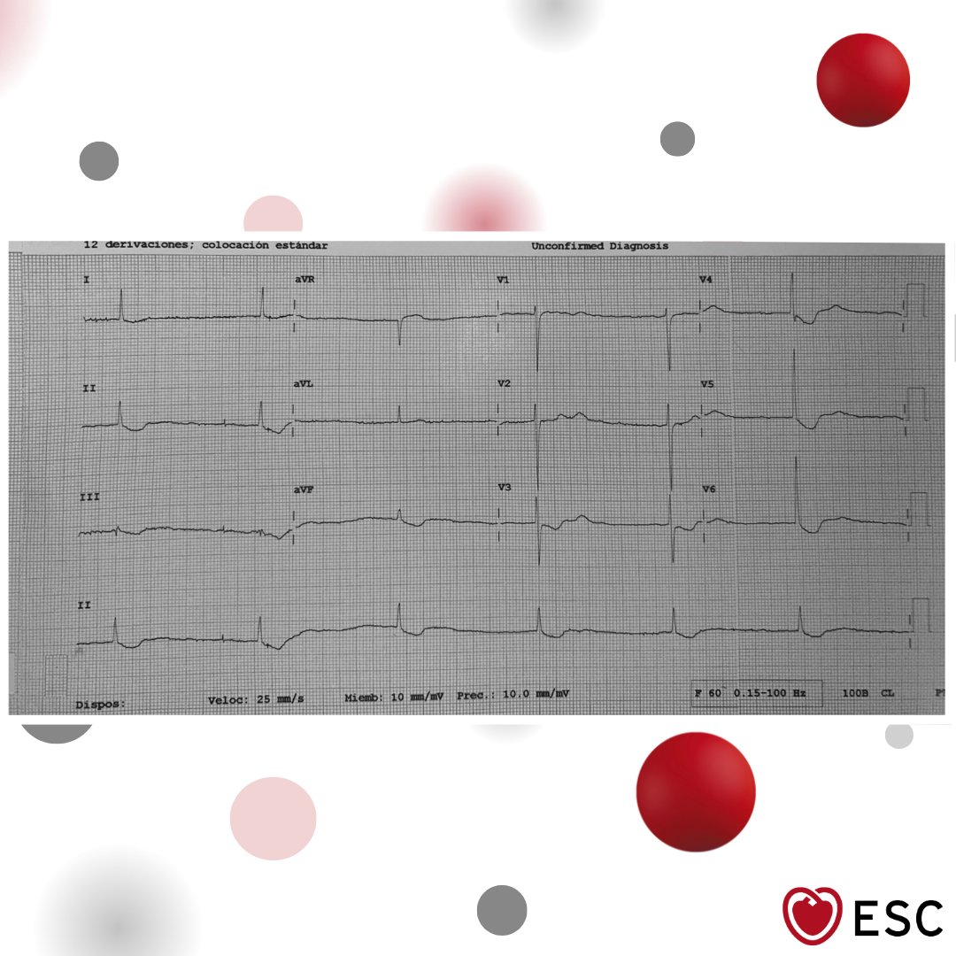 escardio's tweet image. #ImageOfTheWeek
by José Carlos Campos Barba, Guadalupe Lisseth Hernandez González, and Jorge Daniel Lara Martínez from Instituto Nacional de Cardiología Ignacio Chávez, Mexico City, Mexico.

A 71-year-old woman with permanent atrial fibrillation presents with dizziness, yellow…