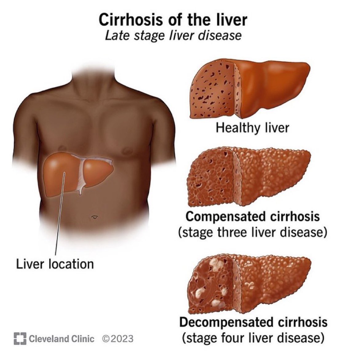 If you drink the following items, you are at a risk of liver cirrhosis!

Soda
Beer
Whisky
Brandy
Vodka
Gin
Wine
Rum