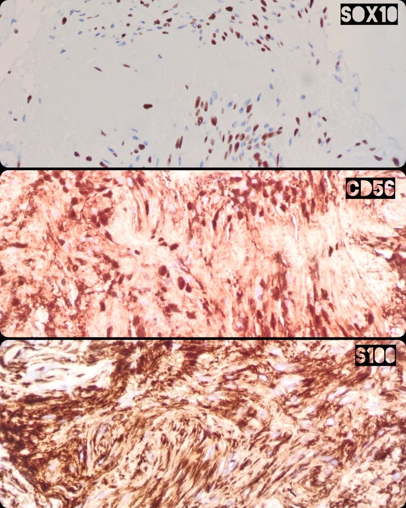 💉 EUS.  Hepatogatric ligament nodule.
🔬 Schwannoma.

#Cytology #CytoPath #PathX #Cytopatholgy