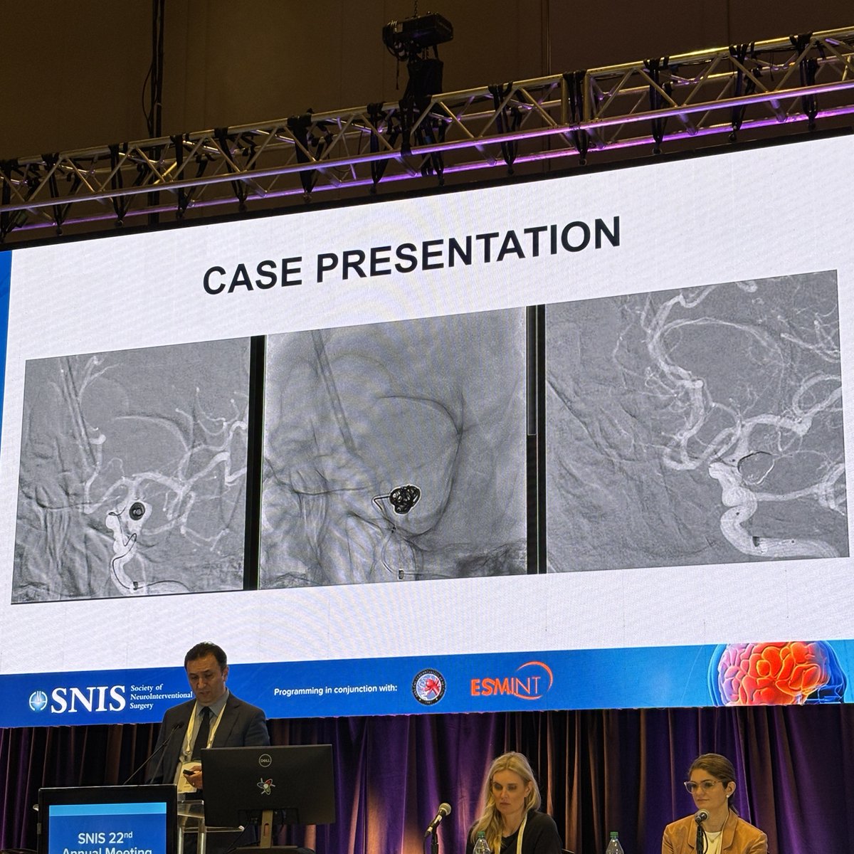JNIS (@jnis_bmj) on Twitter photo <a href="/MajidiShahram/">Shahram Majidi, MD</a> showing the results of the TORNADO-US which studies outcomes of Nautilus-assisted coil embolization for ruptured aneurysms. #SNIS2025 @SNISInfo <a href="/esmintsociety/">ESMINT Society</a> <a href="/cvsection/">CV Section</a> <a href="/fcalbuquerque51/">Felipe C. Albuquerque</a> <a href="/dr_mchen/">Michael Chen, MD</a> <a href="/DanniDiestro/">Dr. DiestroKE</a> <a href="/MattAmansMD/">Matthew Amans</a> <a href="/ducruetaf/">Andrew Ducruet</a> <a href="/MattFusco_MD/">Matt Fusco</a> <a href="/DrAltschul/">Dorothea Altschul MD FAHA FSVIN</a> <a href="/MajidiShahram/">Shahram Majidi, MD</a> showing the results of the TORNADO-US which studies outcomes of Nautilus-assisted coil embolization for ruptured aneurysms. #SNIS2025 @SNISInfo <a href="/esmintsociety/">ESMINT Society</a> <a href="/cvsection/">CV Section</a> <a href="/fcalbuquerque51/">Felipe C. Albuquerque</a> <a href="/dr_mchen/">Michael Chen, MD</a> <a href="/DanniDiestro/">Dr. DiestroKE</a> <a href="/MattAmansMD/">Matthew Amans</a> <a href="/ducruetaf/">Andrew Ducruet</a> <a href="/MattFusco_MD/">Matt Fusco</a> <a href="/DrAltschul/">Dorothea Altschul MD FAHA FSVIN</a>
