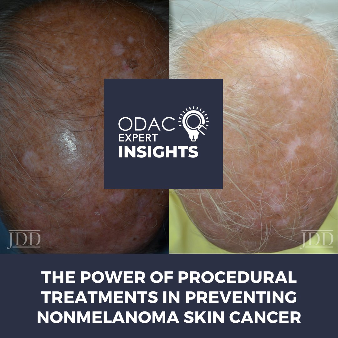 July is UV Awareness Month. At the 2025 <a href="/ODAC_Derm/">ODAC Dermatology Conference</a>, C. William Hanke, MD, presented on preventing NMSC through procedural treatments. 

Read this session summary from <a href="/nextsteps_derm/">Next Steps in Derm</a>: 🔗ow.ly/VvZw50WpCXe

#SkinCancerPrevention #ProceduralDermatology #UVAwarenessMonth