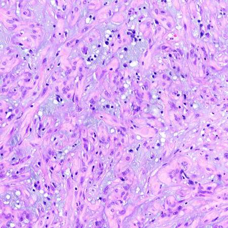 CraigHorbinski's tweet photo. Suprasellar/hypothalamic mass with a PRKCA mutation. Diagnosis? (I'll strum a few CHORDs on my guitar while you think about it.) #pathology #neuropath #pathtwitter https://t.co/DsU2nk6j4o