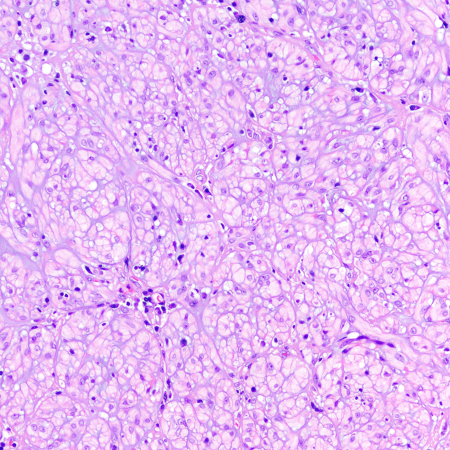 CraigHorbinski's tweet photo. Suprasellar/hypothalamic mass with a PRKCA mutation. Diagnosis? (I'll strum a few CHORDs on my guitar while you think about it.) #pathology #neuropath #pathtwitter https://t.co/DsU2nk6j4o