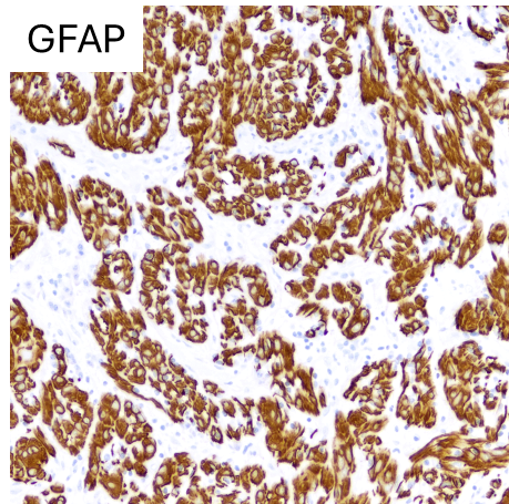 CraigHorbinski's tweet photo. Suprasellar/hypothalamic mass with a PRKCA mutation. Diagnosis? (I'll strum a few CHORDs on my guitar while you think about it.) #pathology #neuropath #pathtwitter https://t.co/DsU2nk6j4o