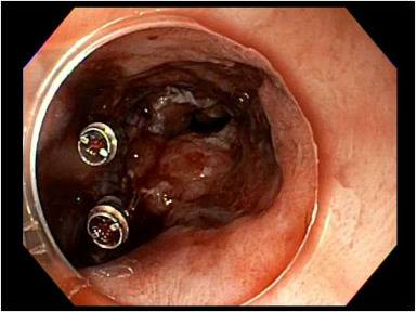 Erica Loon et al perform "Closure of esophageal perforation after stricture dilation with novel through-the-scope clip." videogie.org/article/S2468-…

#GITwitter 

<a href="/EricaLoonDO/">Erica Loon, DO</a> <a href="/nataliejowilson/">Natalie Wilson, MD</a> <a href="/BilalMohammadMD/">Mohammad Bilal, MD</a>