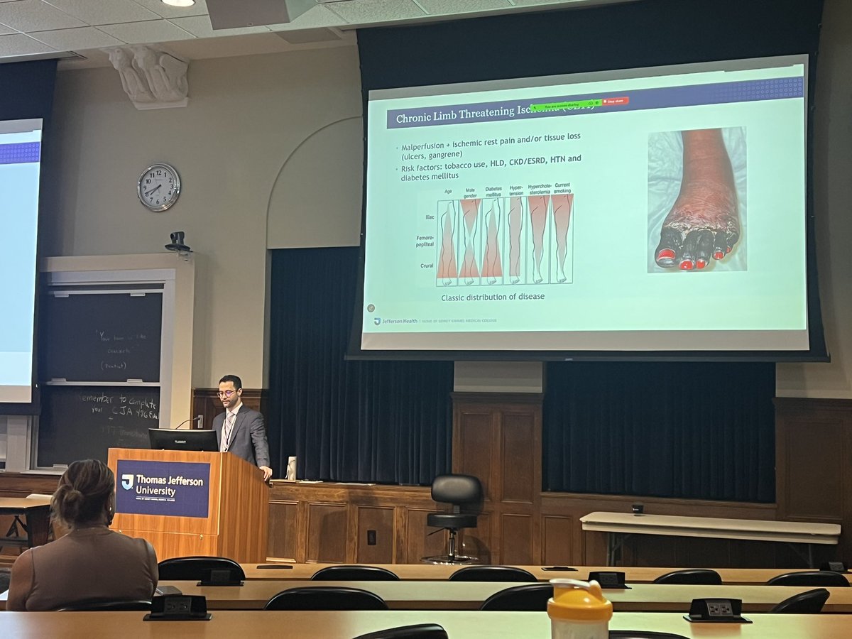 Thomas Jefferson Vascular Surgery (@jeffvascsurg) on Twitter photo Congratulations to Dr <a href="/AruRobbie/">Robbie Aru, M.D.</a> on an engaging talk on the contemporary management of #CLTI from #pedalbypass and #limflow to #skinsubstitute and #multidisciplinary care! #limbpreservation #PAD Congratulations to Dr <a href="/AruRobbie/">Robbie Aru, M.D.</a> on an engaging talk on the contemporary management of #CLTI from #pedalbypass and #limflow to #skinsubstitute and #multidisciplinary care! #limbpreservation #PAD