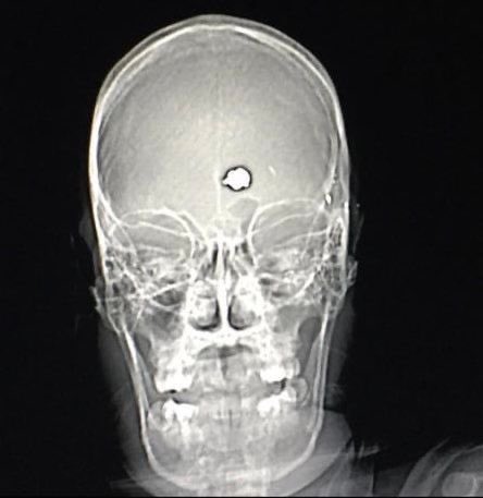 In the 1980s, a man with severe OCD shot himself in the head in an attempt to commit suicide. Instead of killing him, the bullet destroyed the part of his brain responsible for his OCD, and he went on to become a straight-A college student five years later.